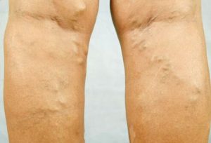 varicose veins