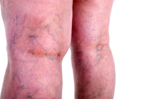 12 Blog Posts on the Best Herbs for Varicose Veins